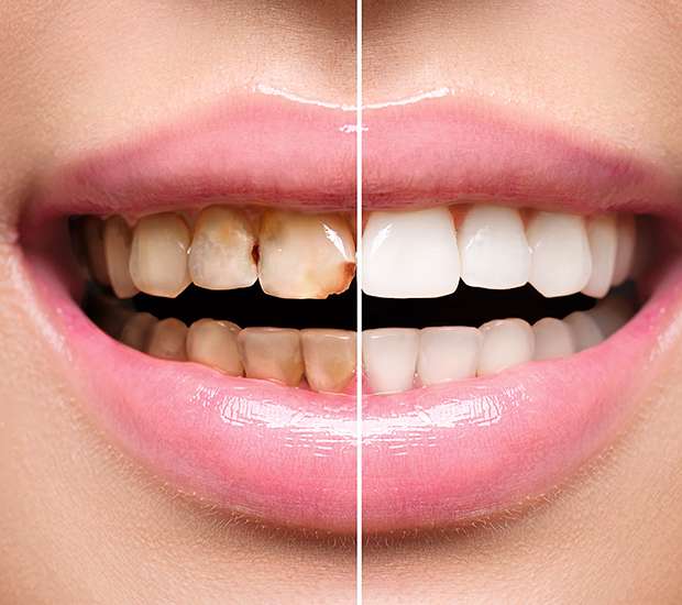 San Rafael Dental Implant Restoration