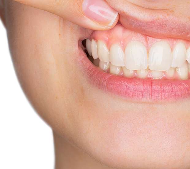 San Rafael Gum Disease